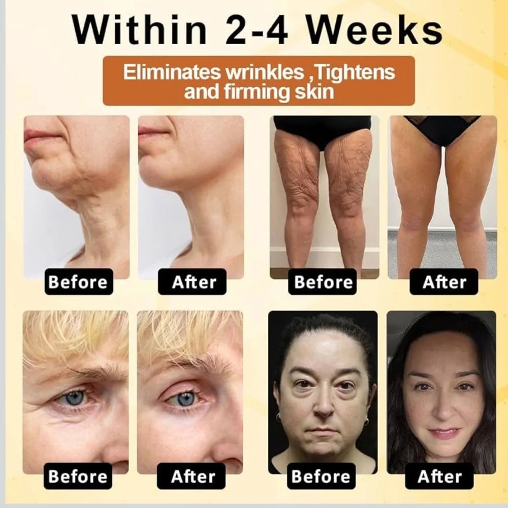 Botoxmix Bee Venom Treatment